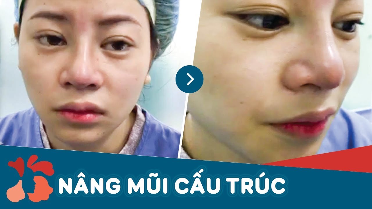 Mũi gồ, mũi khoằm, mũi lệch, vẹo khắc phục như thế nào?