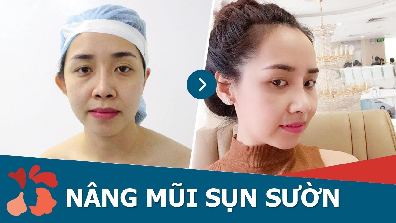 Tái khám nâng mũi sụn sườn gây mê sau 10 ngày