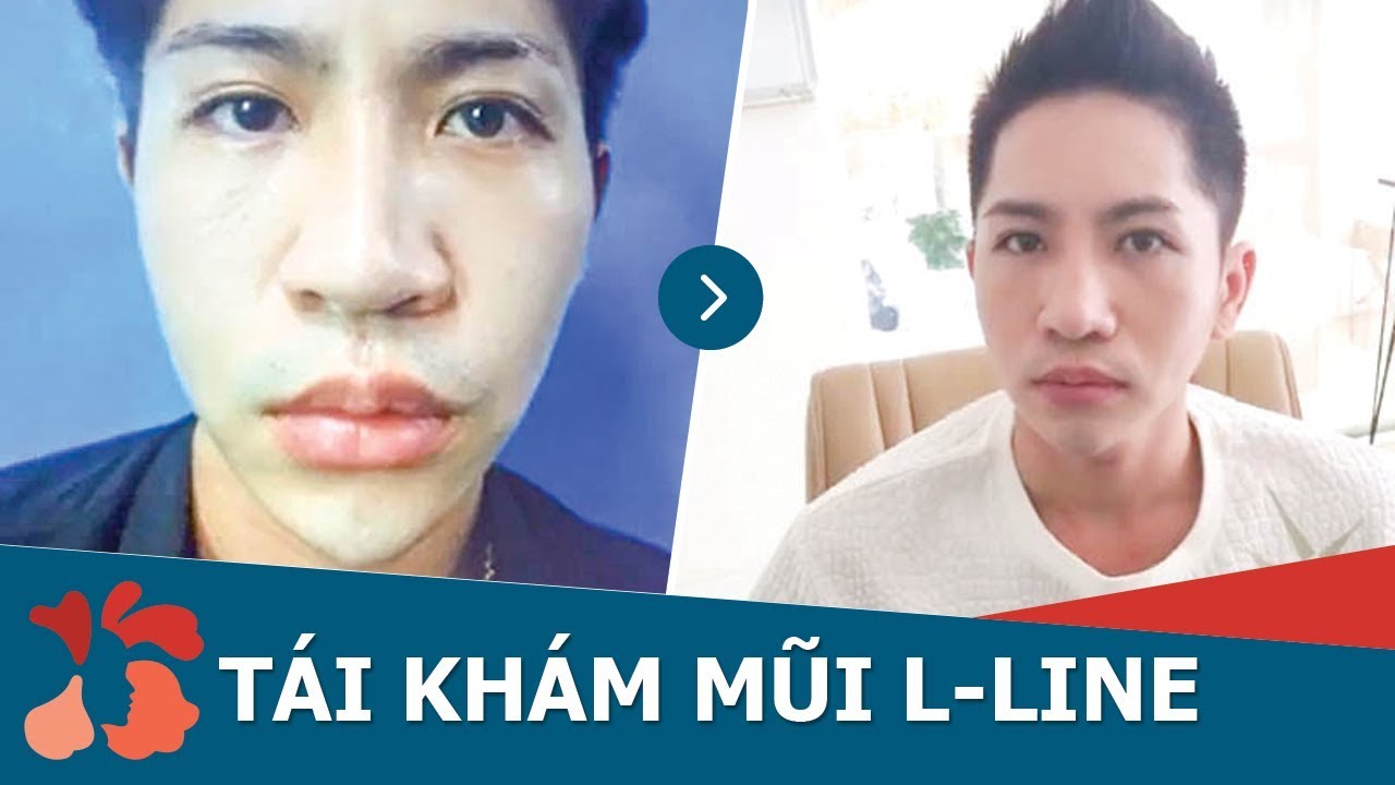 Video tái khám nâng mũi L-Line sau 3 tháng phẫu thuật