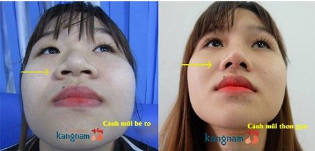 Khách hàng Kangnam chia sẻ cắt cánh mũi bao lâu thì lành?