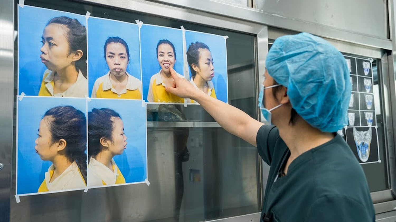 TS.BS Richard Huy nhận định về tình trạng hàm hô của Trà My