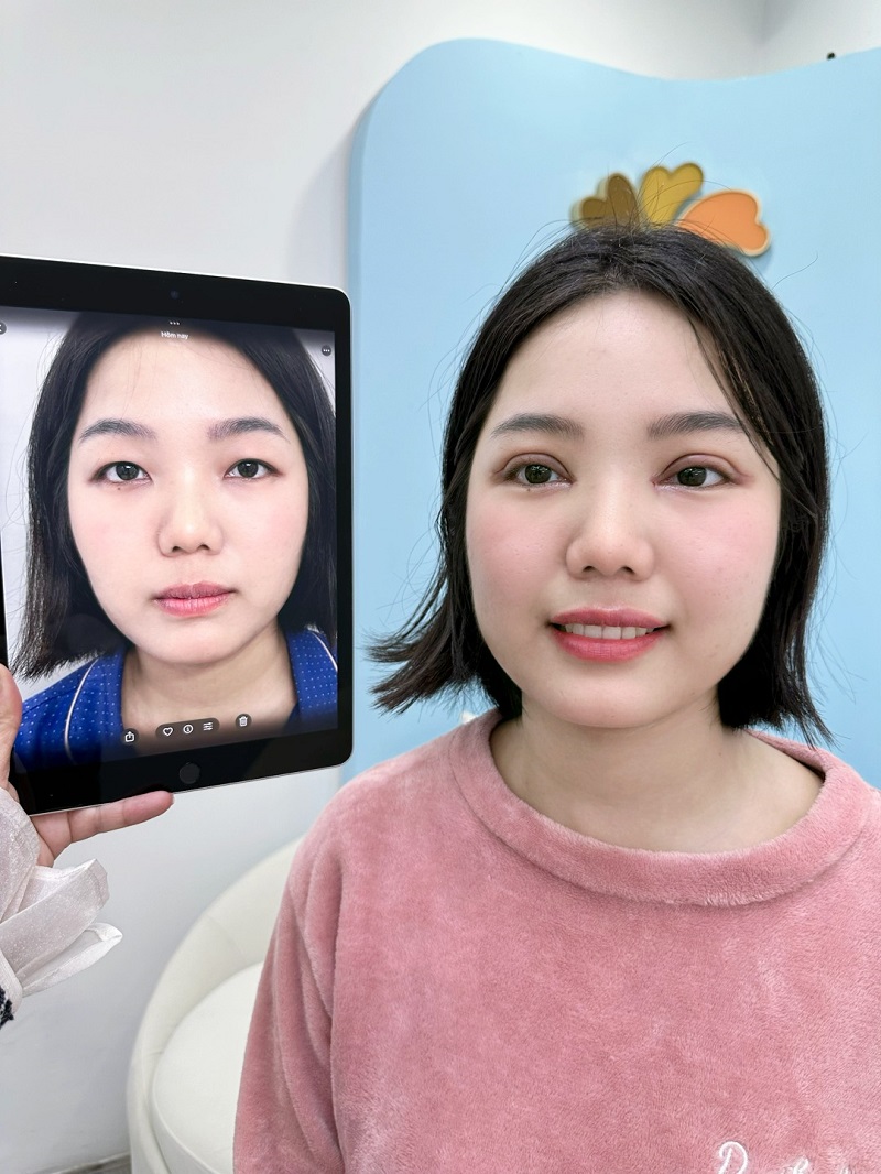 Sau khi cắt mí khách hàng sẽ gặp tình trạng sưng tấy