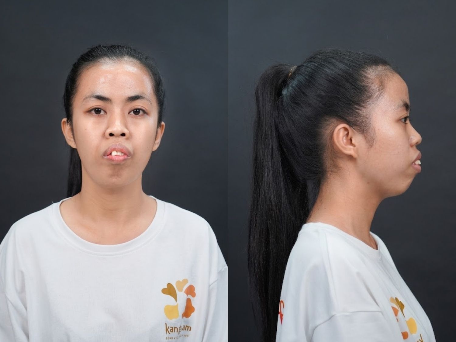 Ngoại hình trước phẫu thuật của Trà My