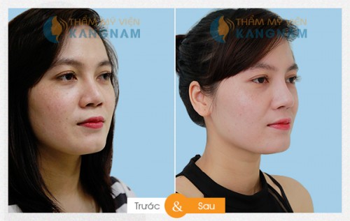 Theo chân khách hàng nâng mũi S-line 3D tại bệnh viện thẩm mỹ Kangnam