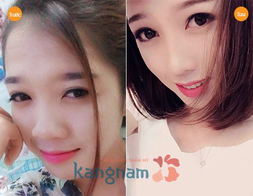 “Tận mắt” 5 màn “lột xác” ngoạn mục chỉ nhờ nâng mũi