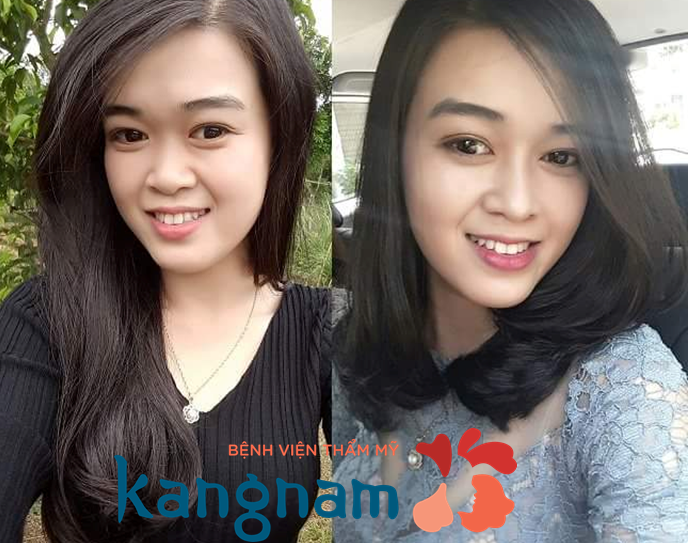 Cuộn cánh mũi giá bao nhiêu?