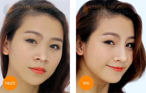 Bí quyết sở hữu mũi xinh như sao Hàn