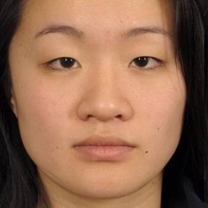 Cánh mũi và đầu mũi to thì phải làm sao?