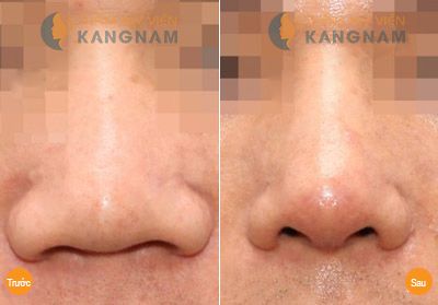 Tiến hành thu gọn cánh mũi có gây đau đớn gì không?