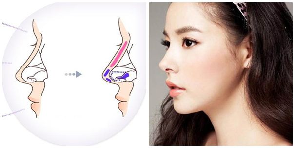 Chi phí nâng mũi bọc sụn Hàn Quốc ở Hà Nội bao nhiêu tiền?