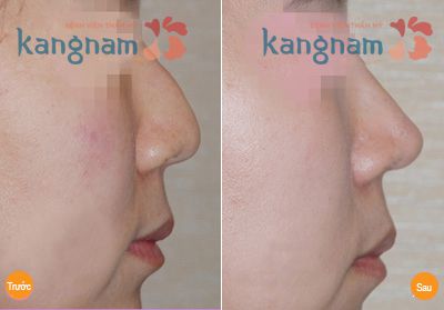 Khách hàng Kangnam chia sẻ có nên sửa mũi gồ để có dáng mũi đẹp không?