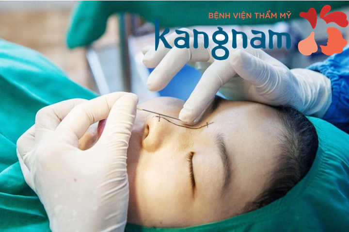 Giá nâng mũi bằng chỉ có đắt không?