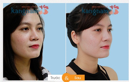 Chị Thanh Hường: Tôi đã sửa mũi hỏng sau 2 lần nâng như thế nào?