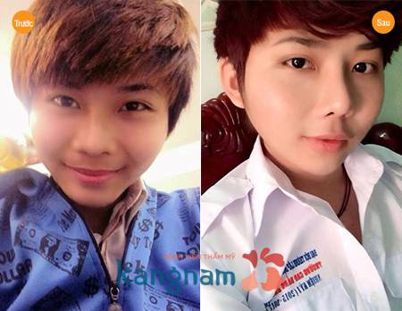 “Nâng mũi giúp tôi tự tin hơn với ngoại hình của mình” – Lê Quang Lộc