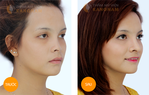 KHUÔN MẶT BẠN SẼ THAY ĐỔI THẾ NÀO SAU KHI PHẪU THUÂT NÂNG MŨI?