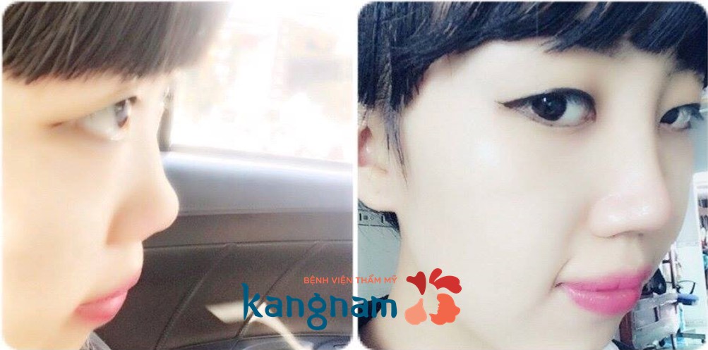 Hình ảnh trước và sau khi nâng mũi của Kim Thảo khiến bạn bè bất ngờ