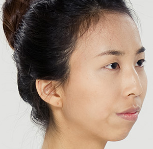 Mũi gồ, lệch phải làm sao?