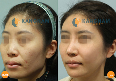 Nâng mũi S line 3D – giải pháp tối ưu cho người mũi gồ