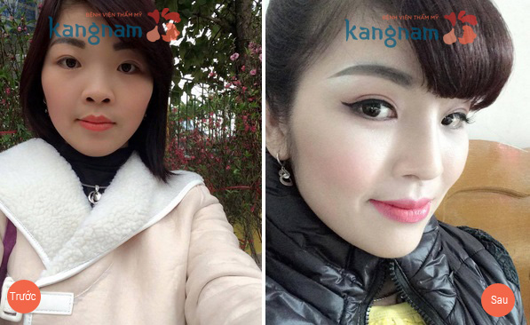 Mũi ngắn hếch là như thế nào và cách khắc phục hiệu quả