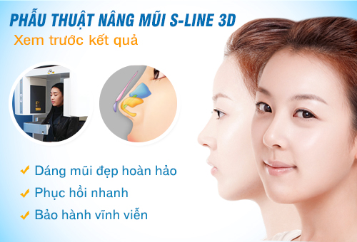 Nâng mũi S-line 3D cho dáng mũi đẹp hoàn mỹ