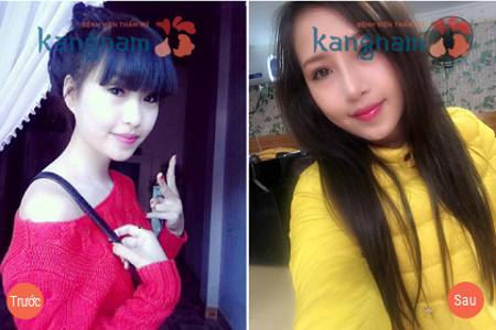 “Mi Yoo” xinh như Hotgirl sau nâng mũi – Bạn có muốn như cô ấy?