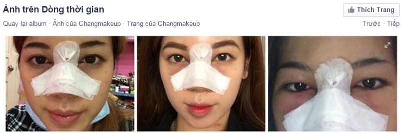 Nghe Changmakeup chia sẻ nâng mũi có bị sưng không?