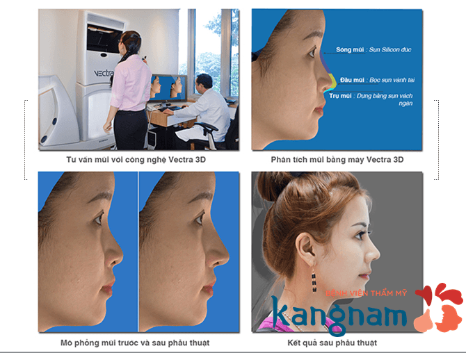 Mô hình giải đáp nâng mũi không phẫu thuật có hại không???