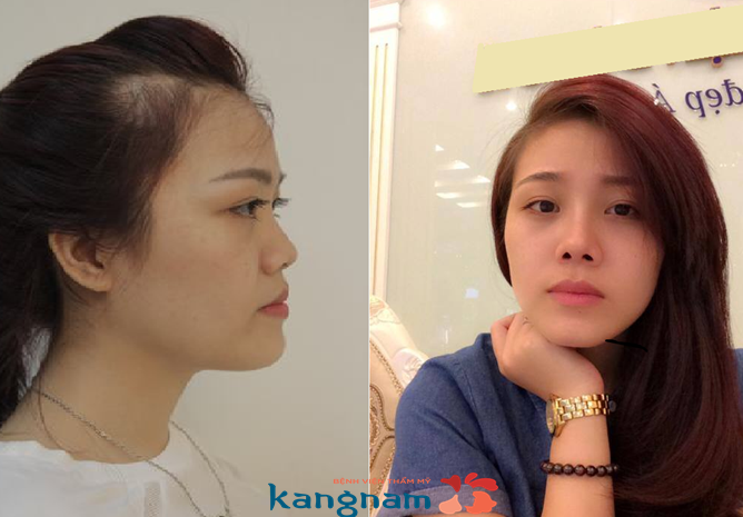 “Mình thật sự rất hài lòng khi nâng mũi ở Kangnam” – Nguyễn Hoài Thu