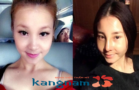 Nữ Hoàng ra dáng “Nữ Hoàng” sau nâng mũi