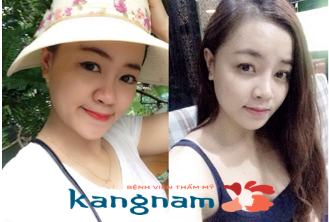 Bất ngờ trước hình ảnh sau nâng mũi bọc sụn của cô gái Quyền Lâm