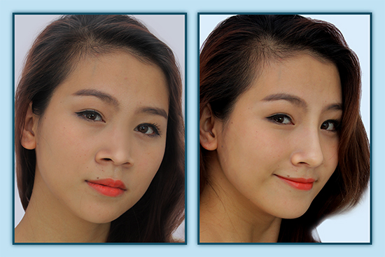Hình ảnh khách hàng trước và sau khi nâng mũi S-line 3D