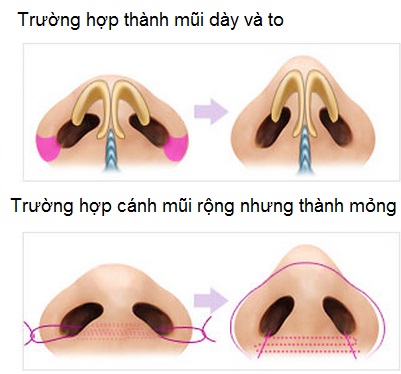 Thu gọn cánh mũi khắc phục cánh mũi to dày hiệu quả