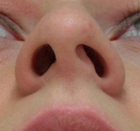 Bệnh vẹo vách ngăn mũi là gì?