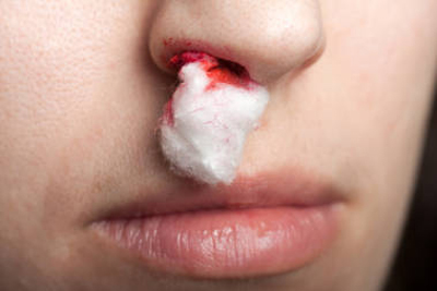 Bệnh vẹo vách ngăn mũi có thể gây chảy máu mũi